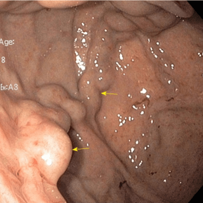 ВРВ желудка